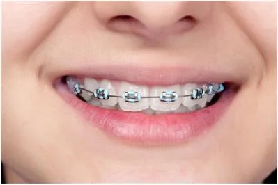Traditional Metal Braces